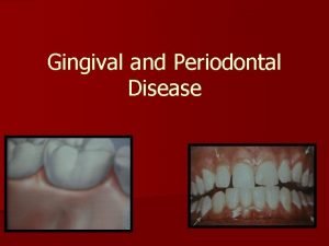 Contour of gingiva in gingivitis