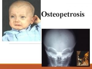 Osteopetrosis Definition A heterogeneous group of heritable conditions