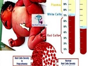 Polycythemia causes