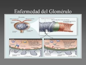 Enfermedad del Glomrulo Grandes Sndromes Glomerulares Clasificacin Clnica