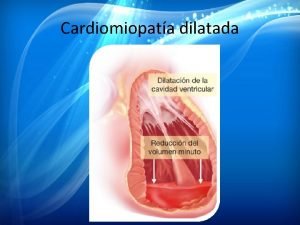 Cardiomiopata dilatada Definicin ue hay q a l