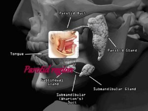 Unyielding nature of parotid fascia means