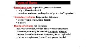 Types of Burns First degree burn superficial partialthickness