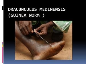 Dracunculiasis