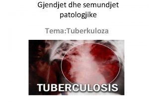 Gjendjet dhe semundjet patologjike Tema Tuberkuloza far sht