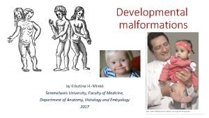 Developmental malformations by Krisztina H Mink Semmelweis University