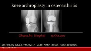 knee arthroplasty in osteoarthritis Ghaem Int Hospital MEHRAN