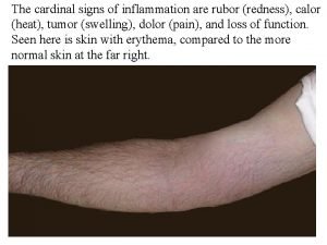 Cardinal symptoms of inflammation