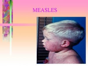 MEASLES DEFINITION Measles is an acute highly contagious