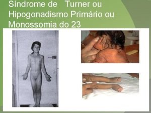 Sndrome de Turner ou Hipogonadismo Primrio ou Monossomia