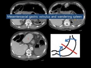 B P Mesenteroaxial gastric volvulus and wandering spleen