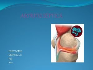 ARTRITIS SPTICA DEISY LPEZ MEDICINA X PUJ 2012