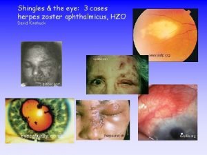 Shingles the eye 3 cases herpes zoster ophthalmicus