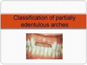 Kennedy classification of partially edentulous arches