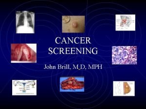 CANCER SCREENING John Brill M D MPH Malignancy