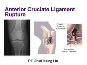 Anterior Cruciate Ligament Rupture PT Chia Hsiung Lin