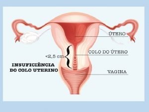 Hemorragias da primeira metade da gravidez GESTAO ECTPICA