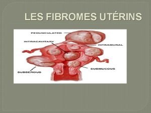 LES FIBROMES UTRINS DEFINITION Un fibrome utrin myome