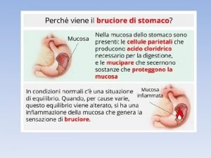 Fisiopatologia dellulcera peptica Fattori Difensivi Fattori Lesivi Acido