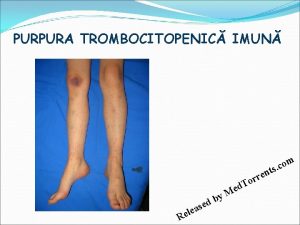 PURPURA TROMBOCITOPENIC IMUN m o c s t