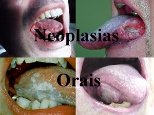 Neoplasias Orais Neoplasia neo novo plasia tecido o