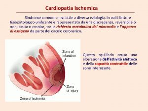 Cardiopatia Ischemica Sindrome comune a malattie a diversa