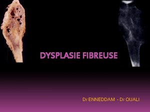 DYSPLASIE FIBREUSE Dr ENNEDDAM Dr OUALI PLAN v