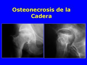 Osteonecrosis de la Cadera Vascularizacin del extremo superior