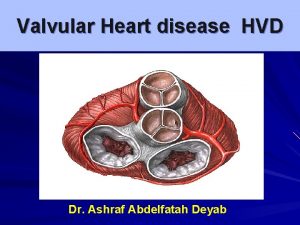 Define mitral stenosis