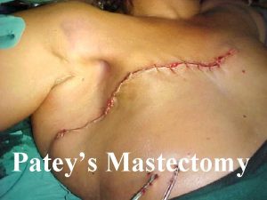 Pateys Mastectomy Pateys Radical Mastectomy Sandeep Kumar MS