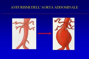 ANEURISMI DELLAORTA ADDOMINALE Aneurismi dellaorta addominale Definizione Epidemiologia