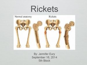 Rickets By Jennifer Eury September 16 2014 5