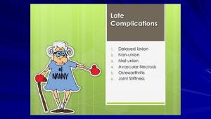 Complications of Fractures 1Nonunion Nonunion consider if fracture