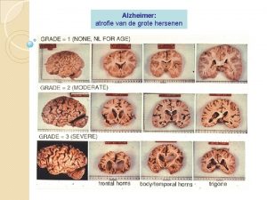 Alzheimer atrofie van de grote hersenen Eiwitten er