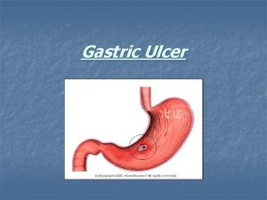 Gastric Ulcer Even though gastric ulcer is a