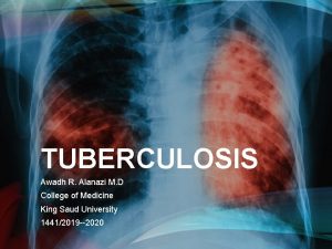 TUBERCULOSIS Awadh R Alanazi M D College of