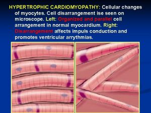 HYPERTROPHIC CARDIOMYOPATHY Cellular changes of myocytes Cell disarrangement