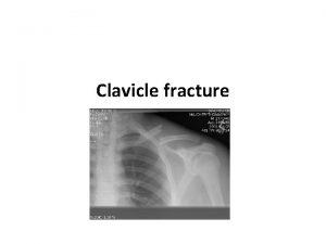 Clavicle fracture Frequency Clavicle fractures involve approximately 5