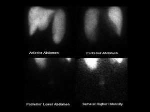 Osteopetrosis Tc99 m sulfur colloid i v intense