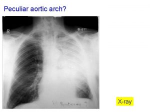 Peculiar aortic arch Ar c h Xray Peculiar