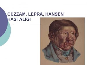 CZZAM LEPRA HANSEN HASTALII 1 CZZAM HASTALIININ TANIMI