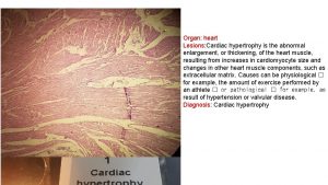 Organ heart Lesions Cardiac hypertrophy is the abnormal