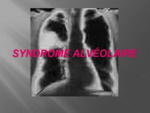 SYNDROME ALVOLAIRE PLAN Introduction Base anatomique Pathognie Moyens