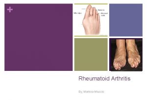 Rheumatoid Arthritis By Marissa Miuccio Definition n What