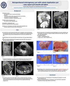 Retroperitoenal enterogenous cyst with colonic duplication cyst case