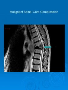 Malignant Spinal Cord Compression What is Malignant Spinal