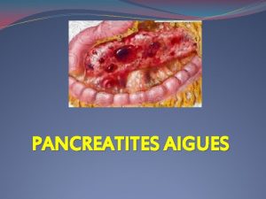 PANCREATITES AIGUES PLAN INTRODUCTION RAPPEL ANATOMIQUE PHYSIOPATHOLOGIE FORMES