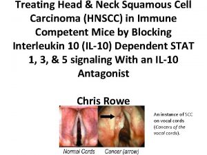Treating Head Neck Squamous Cell Carcinoma HNSCC in