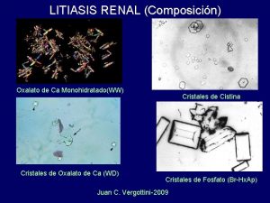 LITIASIS RENAL Composicin Oxalato de Ca MonohidratadoWW Cristales