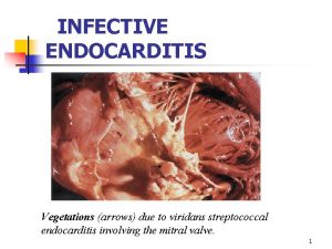 INFECTIVE ENDOCARDITIS Vegetations arrows due to viridans streptococcal